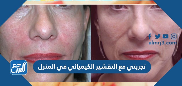 تجربتي مع التقشير الكيميائي في المنزل