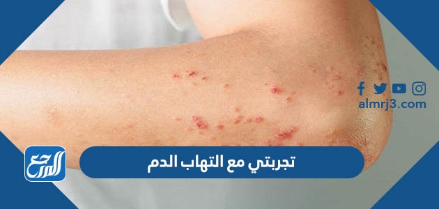 تجربتي مع التهاب الدم