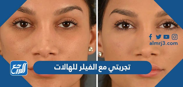 تجربتي مع الفيلر للهالات