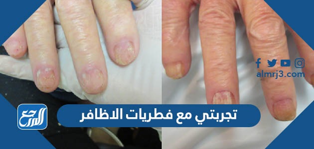 تجربتي مع فطريات الاظافر