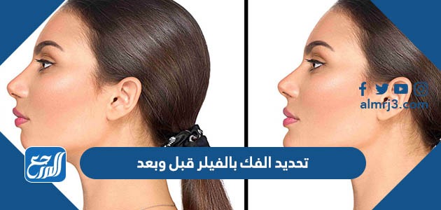 تحديد الفك بالفيلر قبل وبعد