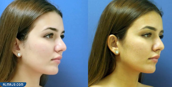 التقشير الكيميائي لعلاج مشاكل البشرة المعرضة للشمس والعوامل الجوية