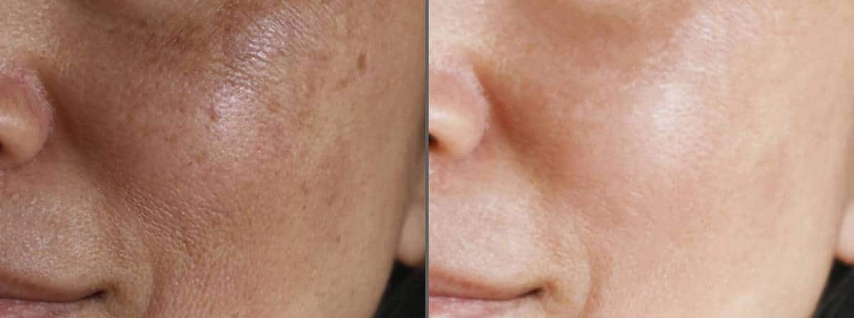 التقشير الكيميائي لعلاج التصبغات والحبوب قبل وبعد