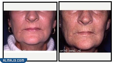 التقشير الكيميائي لعلاج تجاعيد البشرة قبل وبعد