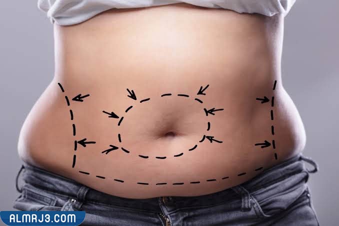 أفضل دكتور شفط دهون ونحت جسم بجدة