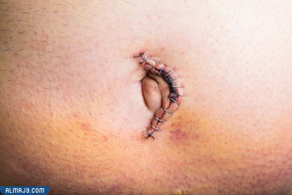 شكل البطن بعد عملية الفتق