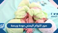 صور التوأم اليمني مودة ورحمة قبل وبعد الفصل