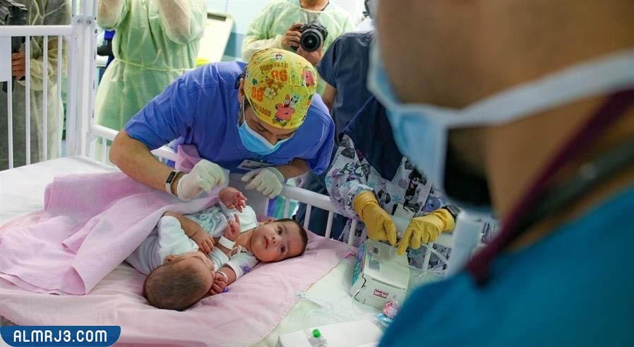 صور التوأم اليمني مودة ورحمة قبل وبعد الفصل