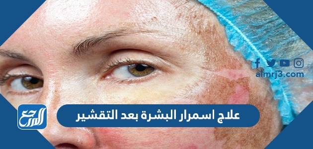 علاج اسمرار البشرة بعد التقشير