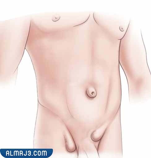 كم يستمر الألم بعد عملية الفتق الإربي؟