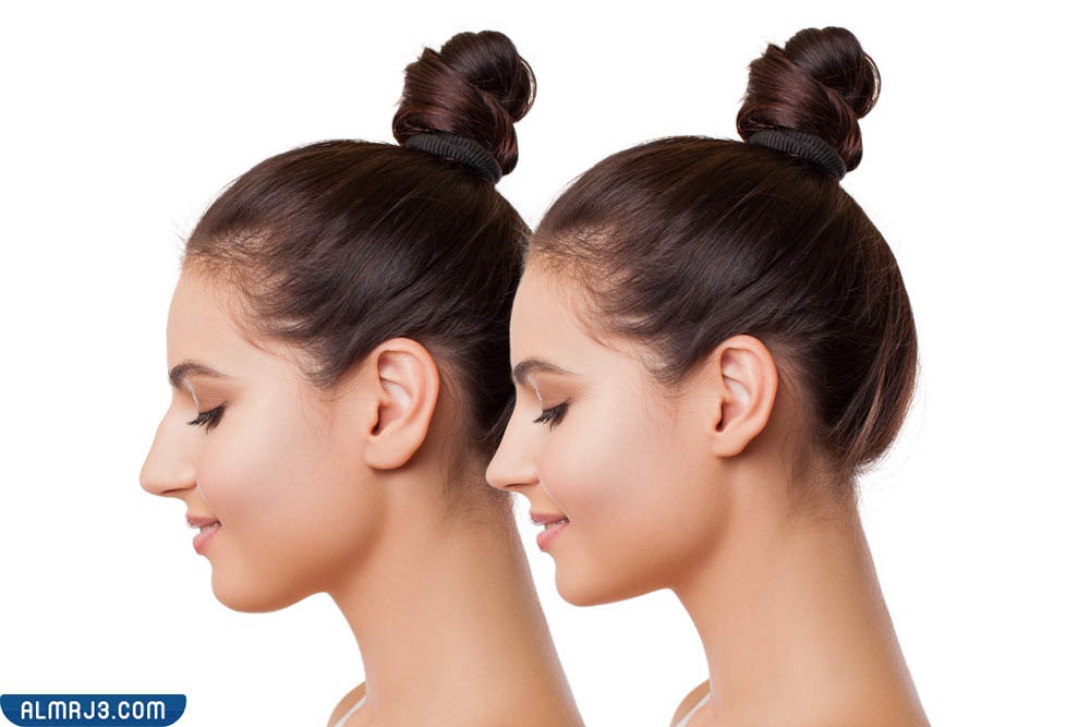 فوائد تحديد الفك بالفيلر