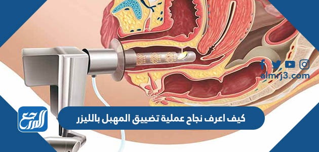 كيف اعرف نجاح عملية تضييق المهبل بالليزر