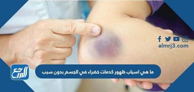 ما هي اسباب ظهور كدمات خضراء في الجسم بدون سبب