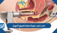 متى تذوب خيوط عملية تضييق المهبل