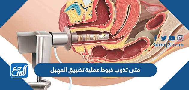 متى تذوب خيوط عملية تضييق المهبل