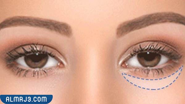 متى تظهر نتائج الفيلر تحت العين