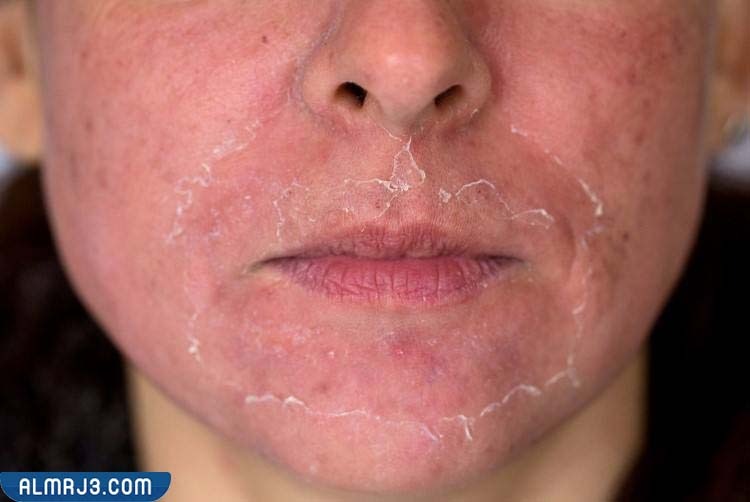 مميزات استخدام التقشير الكيميائي 