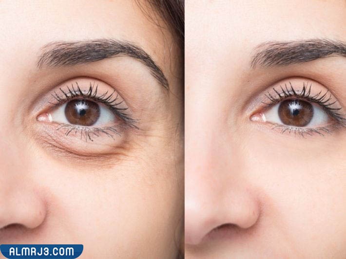 نصائح يجب مراعاتها لتجنب تكتلات الفيلر تحت العين