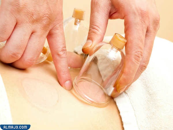 نصائح يجب اتباعها قبل إجراء الحجامة 