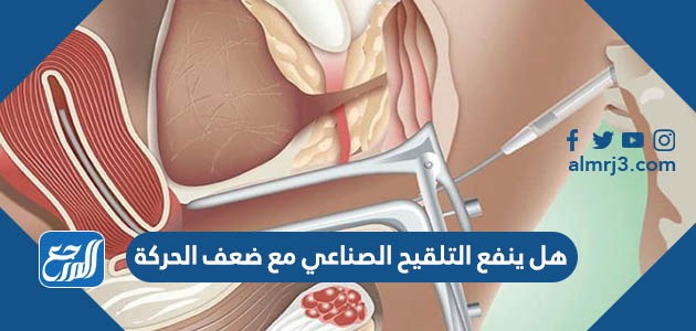 هل ينفع التلقيح الصناعي مع ضعف الحركة