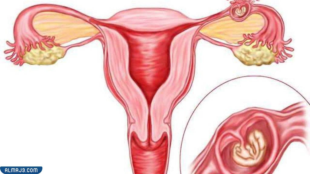 العناصر التي ينتجها الرحم لمنع الحمل 