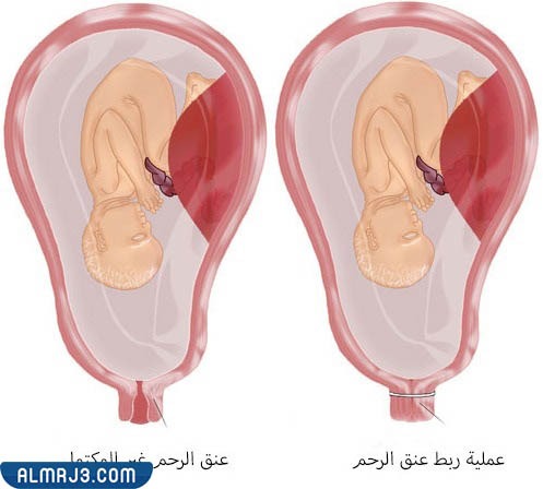 تجارب على ربط الرحم عند الحامل