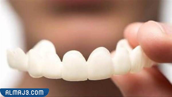 ما هي قشور الأسنان القابلة للإزالة؟