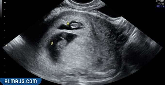 أعراض الحمل بتوأم في الأسبوع الأول