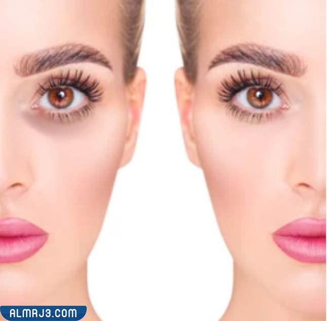 تجربتي مع الفيلر تحت العين 