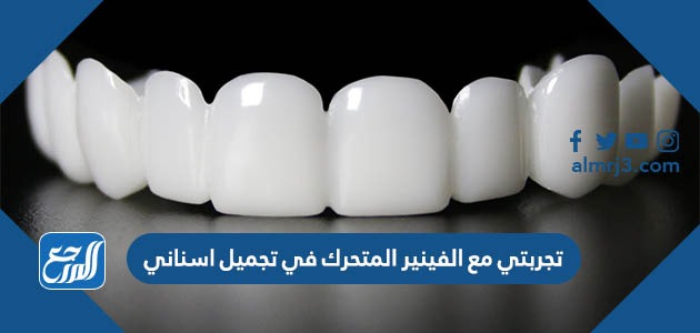 تجربتي مع الفينير المتحرك في تجميل اسناني