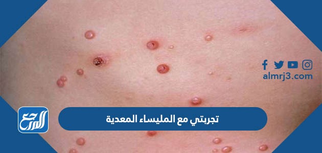 تجربتي مع المليساء المعدية