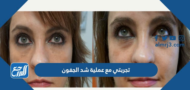 تجربتي مع عملية شد الجفون