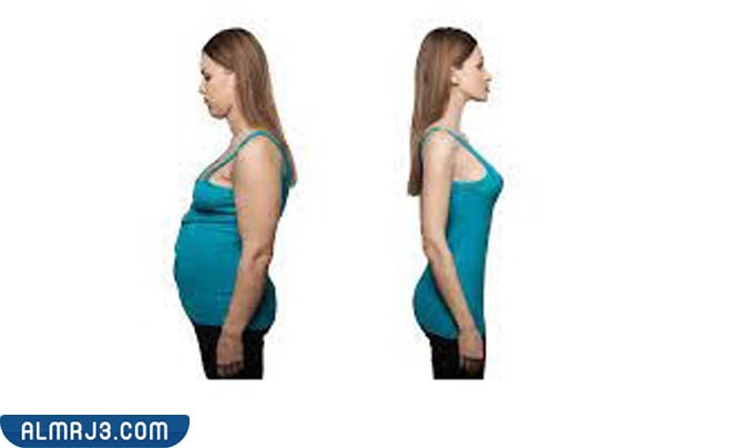 سعر عملية كرمشة المعدة بالمنظار