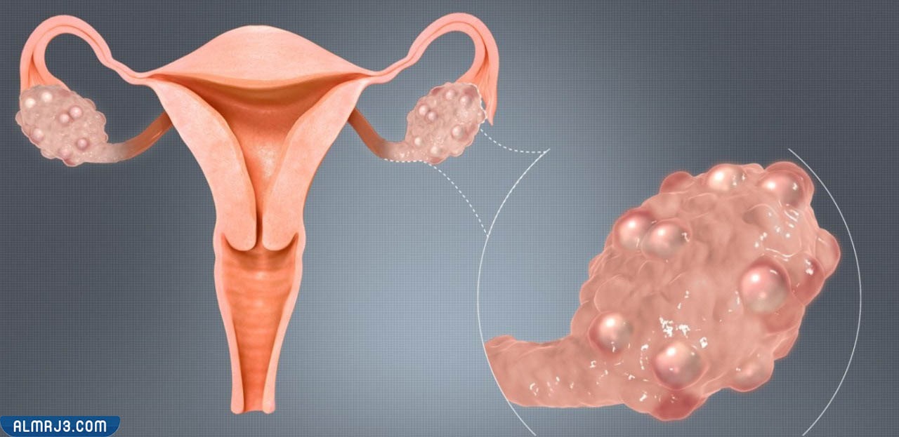 أعراض الإصابة بتكيسات المبايض