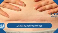 جرح العملية القيصرية يحرقني ما اعراض التهاب جرح العملية القيصرية