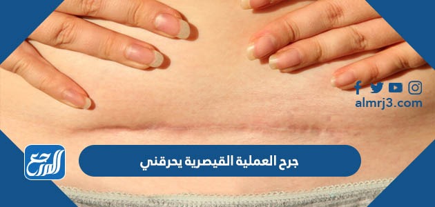 جرح العملية القيصرية يحرقني