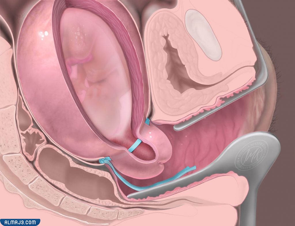 مخاطر ومضاعفات عملية ربط عنق الرحم للحامل