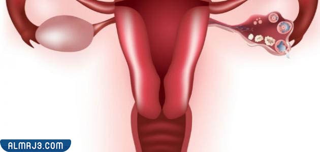 طرق التخلص من كيس المبيض 