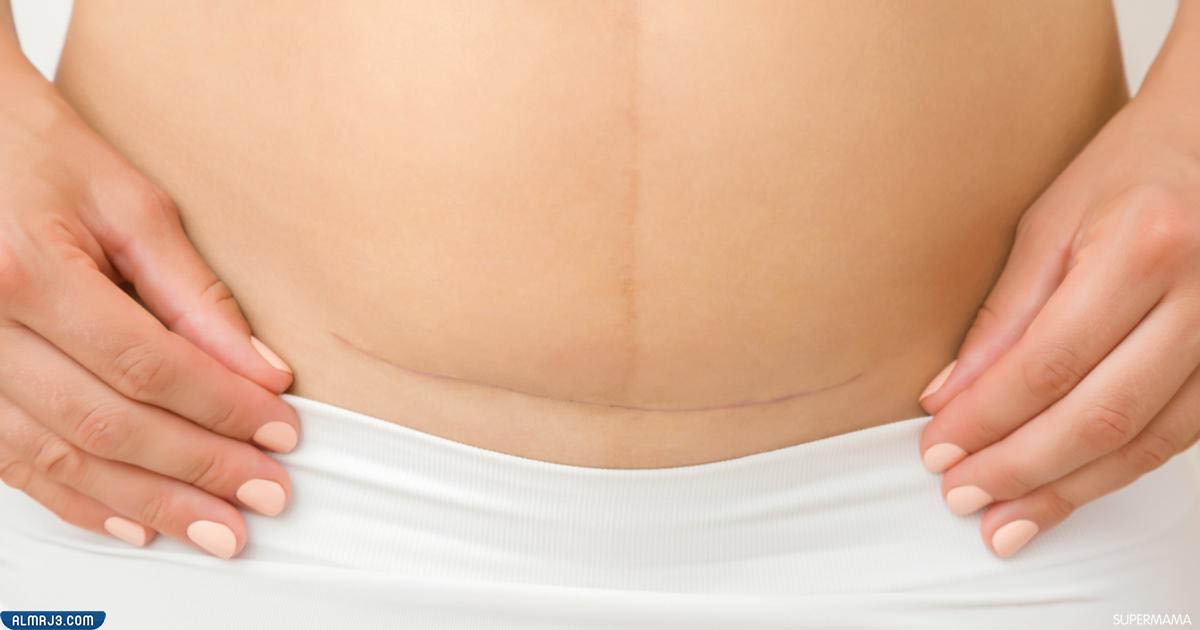 طرق علاج جرح العملية القيصرية 