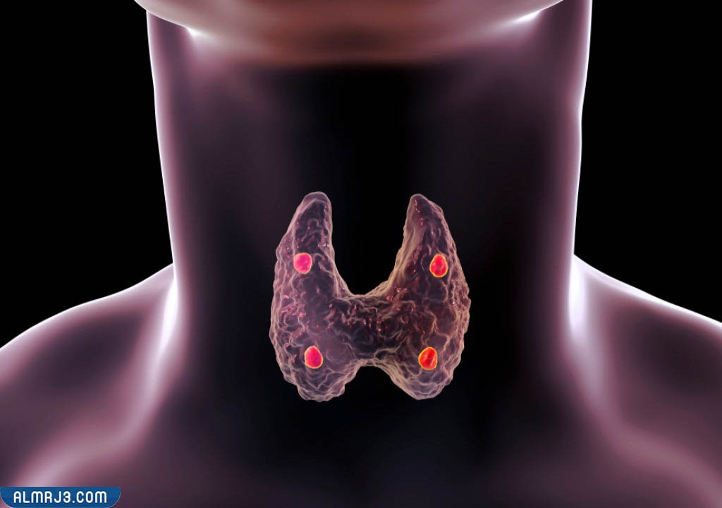 مضاعفات الإصابة بمرض قصور الغدة الدرقية