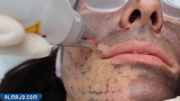 نصائح بعد إجراء الليزر الكربوني