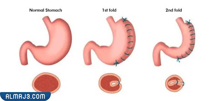 مميزات عملية كرمشة المعدة بالمنظار