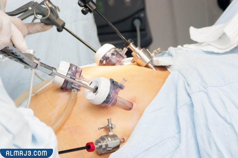 كيف يقوم الطبيب بإجراء عملية كرمشة المعدة بالمنظار؟