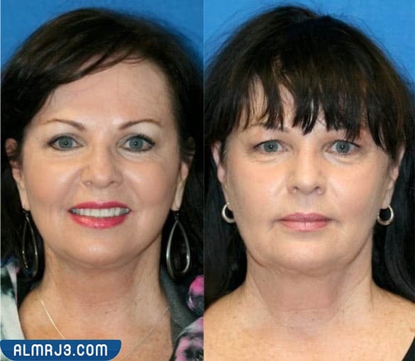 كيف تتم عملية شد الجفون 