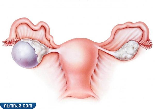 كيف ينزل الكيس المائي على المبيض 