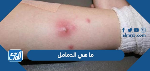 ما هي الدمامل