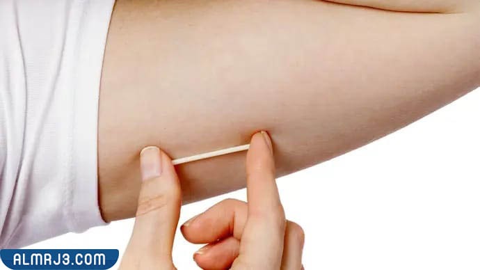 ما هي شريحة منع الحمل