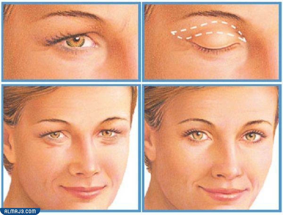ما هي عملية شد الجفون 