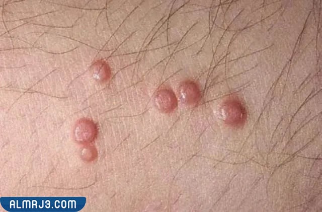 كيفية الوقاية من المليساء المعدية