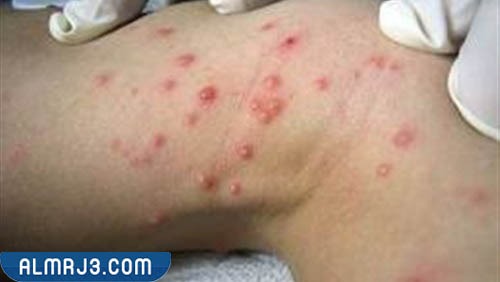 تجربتي مع المليساء المعدية